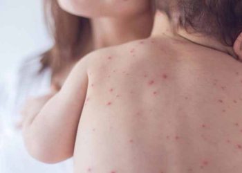 Measles outbreak claims 53 children’s lives in Sindh this year